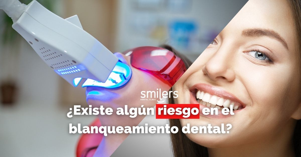 Are There Any Risks in Teeth Whitening?