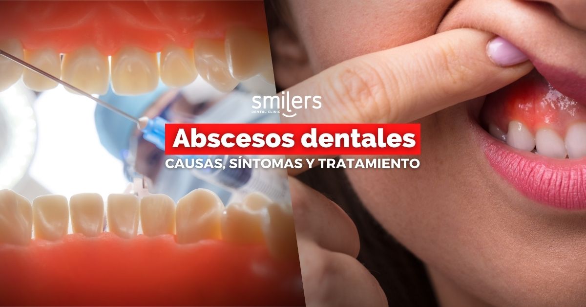 ¿Qué son los abscesos dentales? Causas, síntomas y tratamiento