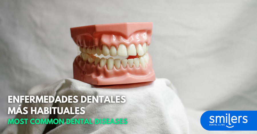 Enfermedades dentales más habituales